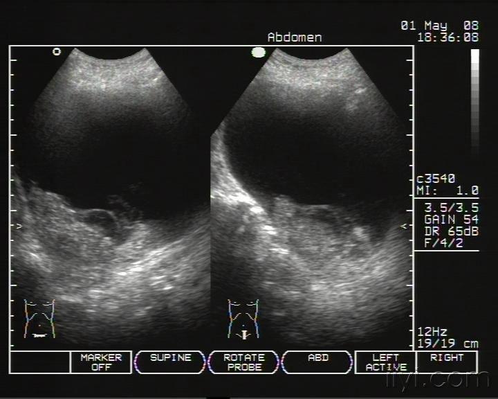 膀胱长息肉的彩超图片图片