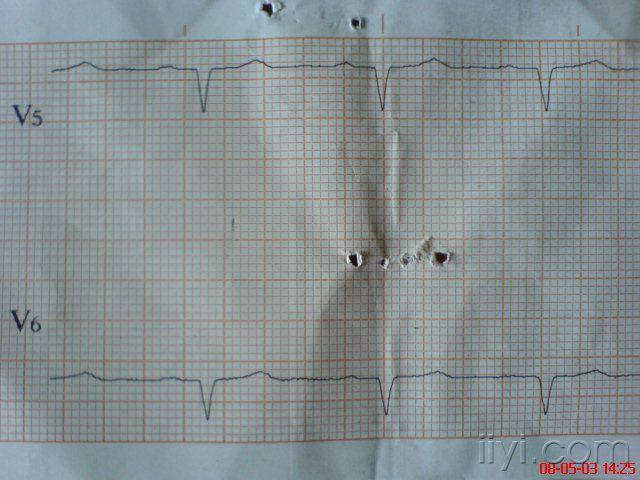 qs型心电图图片