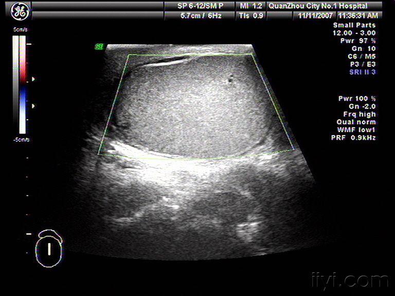 大家看个睾丸扭转的 - 超声医学讨论版 - 爱爱医医学论坛