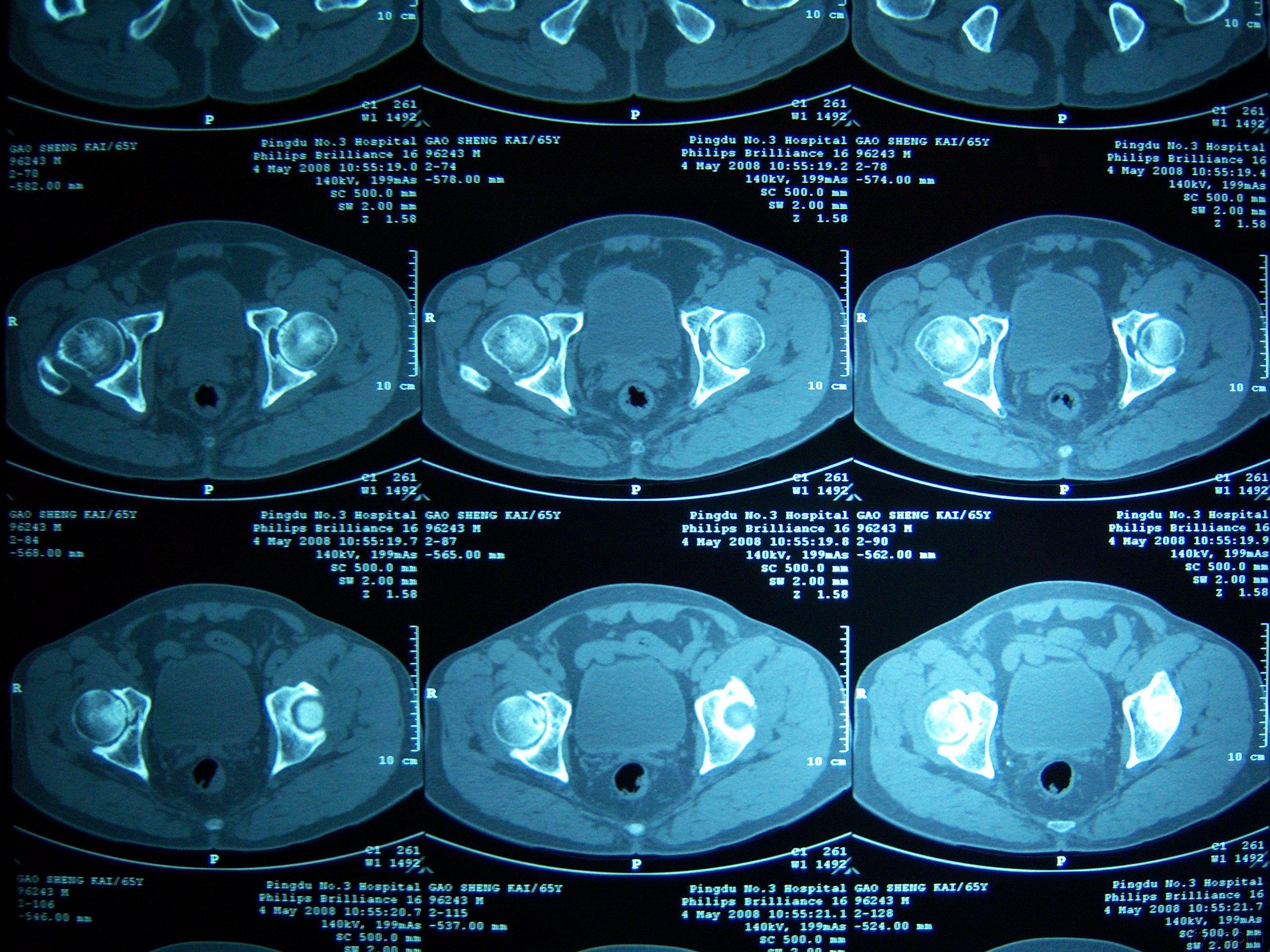 骨盆CT解剖影像图片