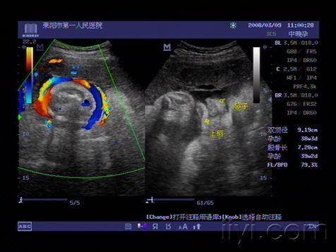 胎儿脐带绕颈及唇部欣赏 超声医学讨论版 爱爱医医学论坛