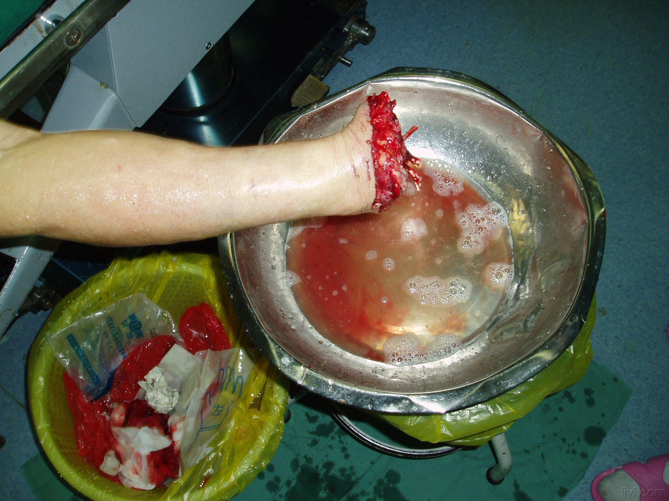 一组断指再植手术图片,供欣赏