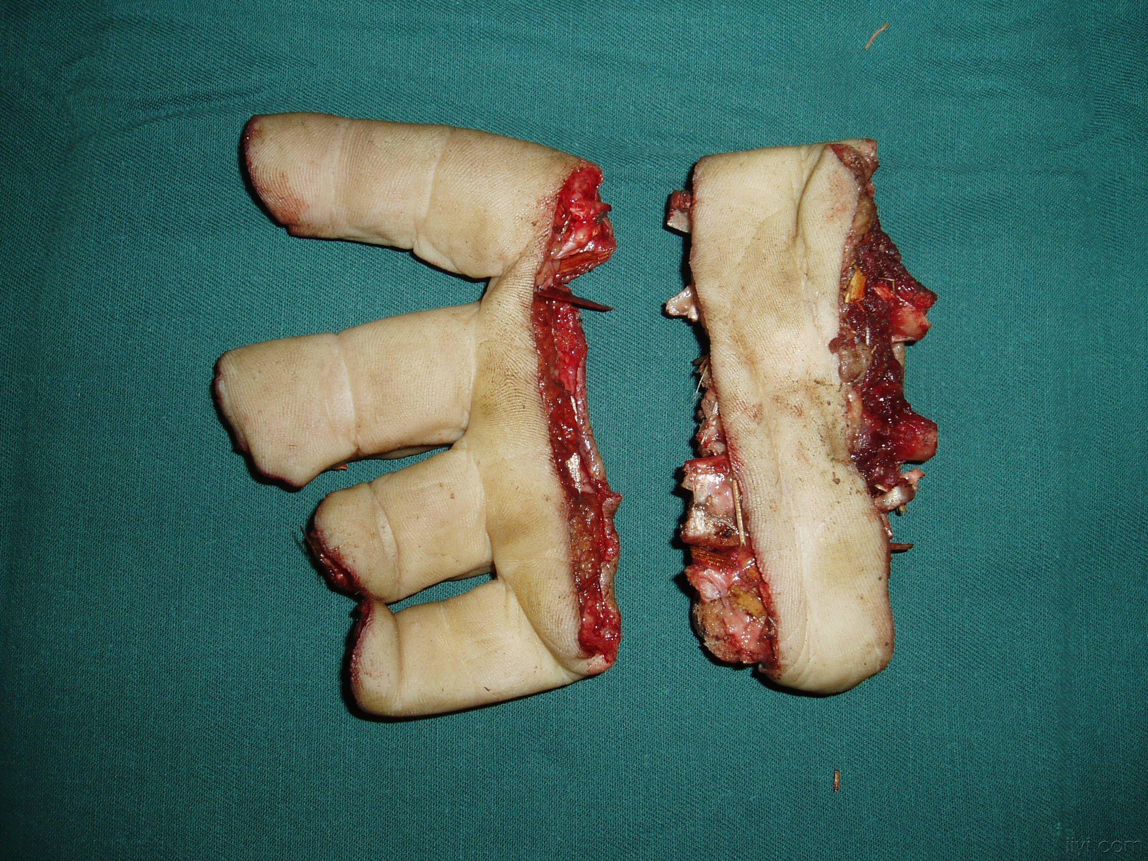 一组断指再植手术图片,供欣赏