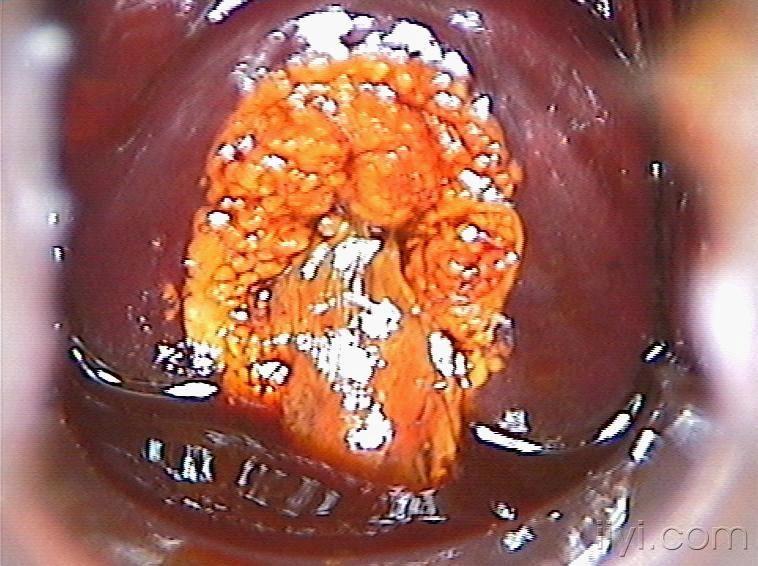 临床常见宫颈糜烂图片