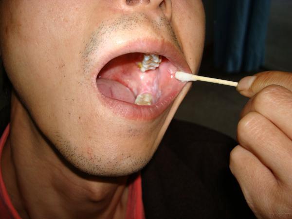 口腔黏膜白斑