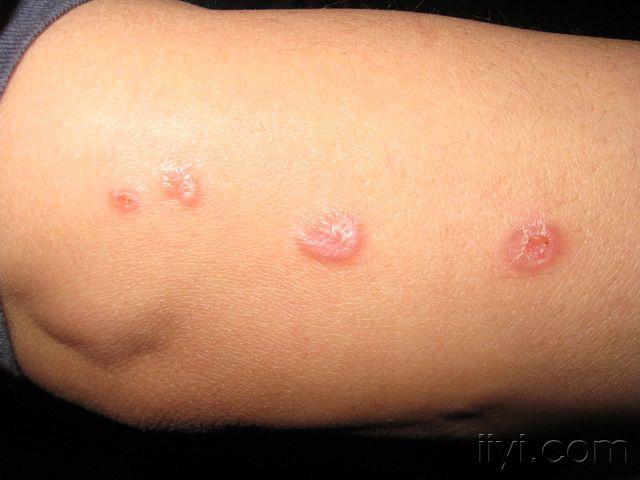 颈部四肢无痛痒丘疹数月余