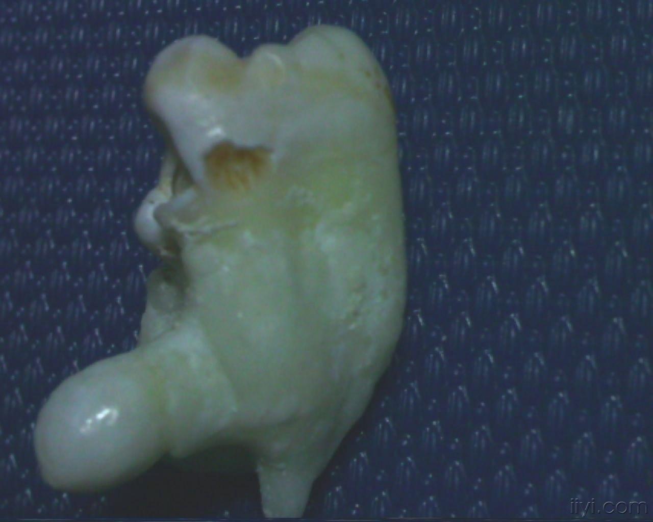 本人见过牙根变异最大的牙