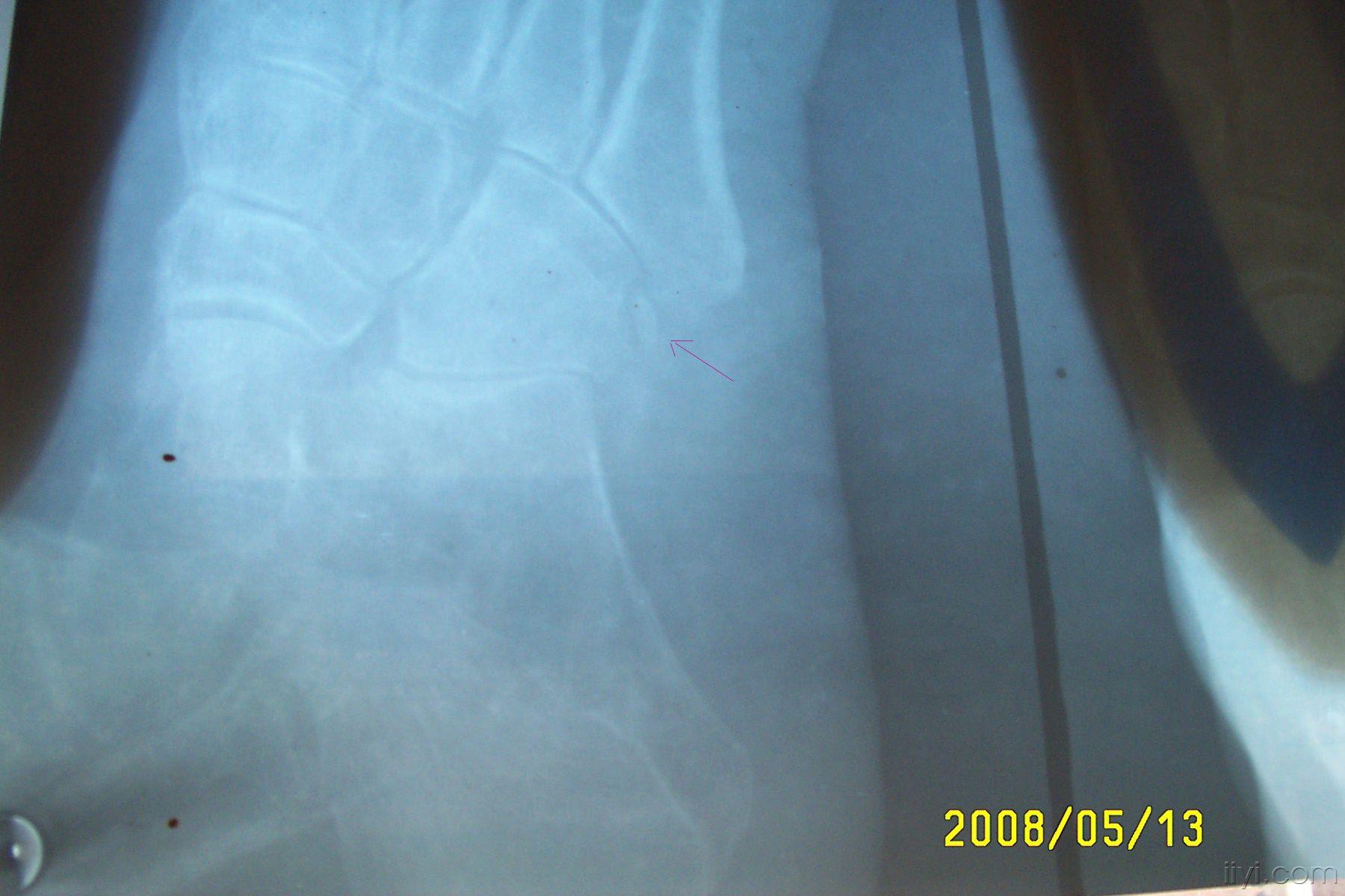 足背砸伤x片如图是不是骨裂