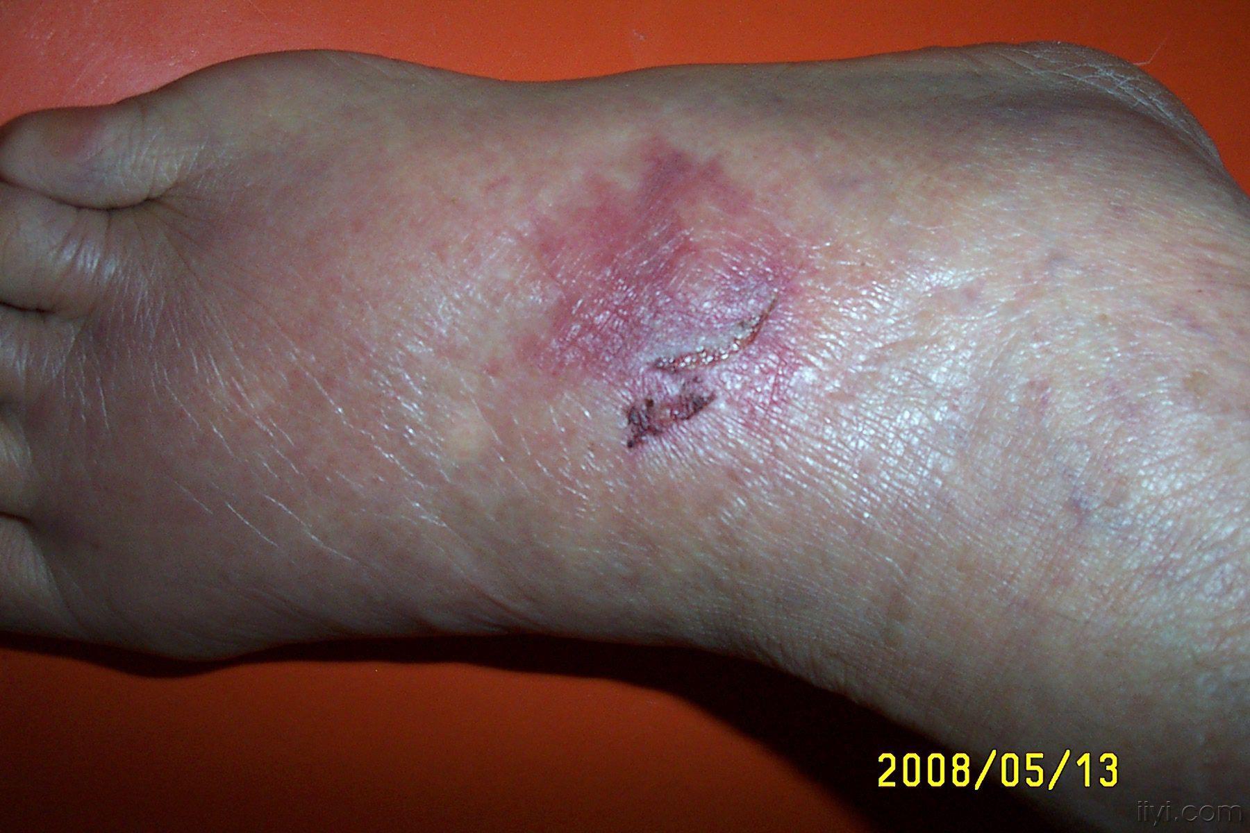 足背砸伤x片如图是不是骨裂