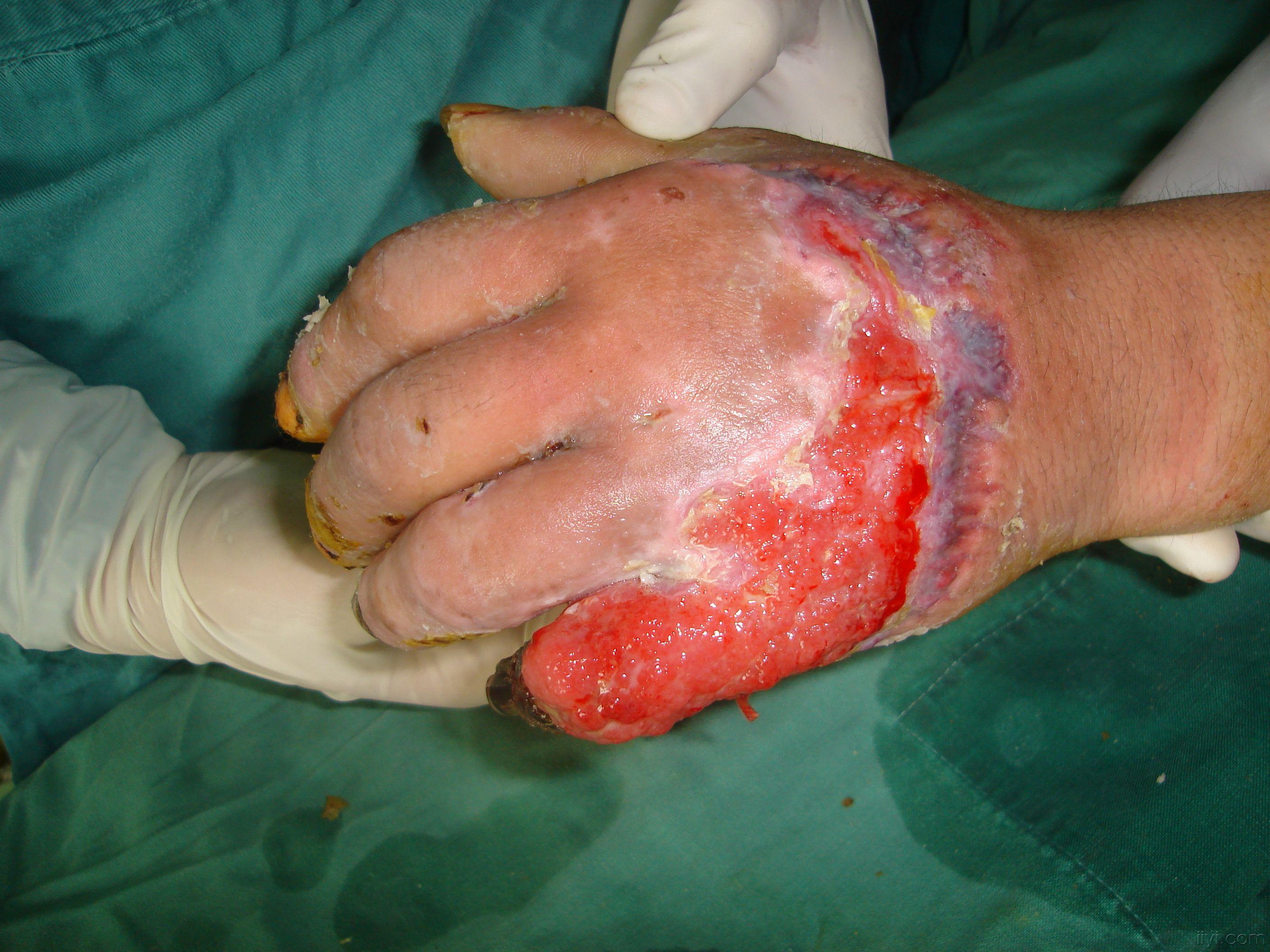 显微手足外科受外伤病例带图片请参考