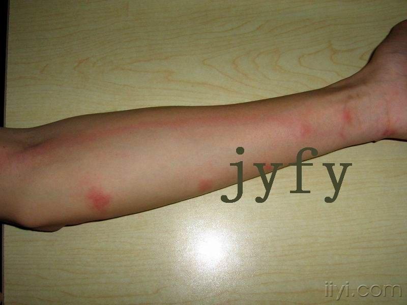 隐翅虫皮炎 - 皮肤及性传播疾病讨论版 - 爱爱医医学论坛