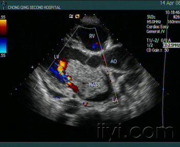 心房黏液瘤典型声像图 - 超声医学讨论版 - 爱爱医医学论坛