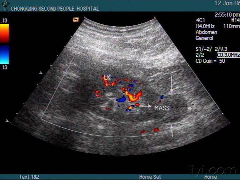 肾肿瘤超声声像图图片