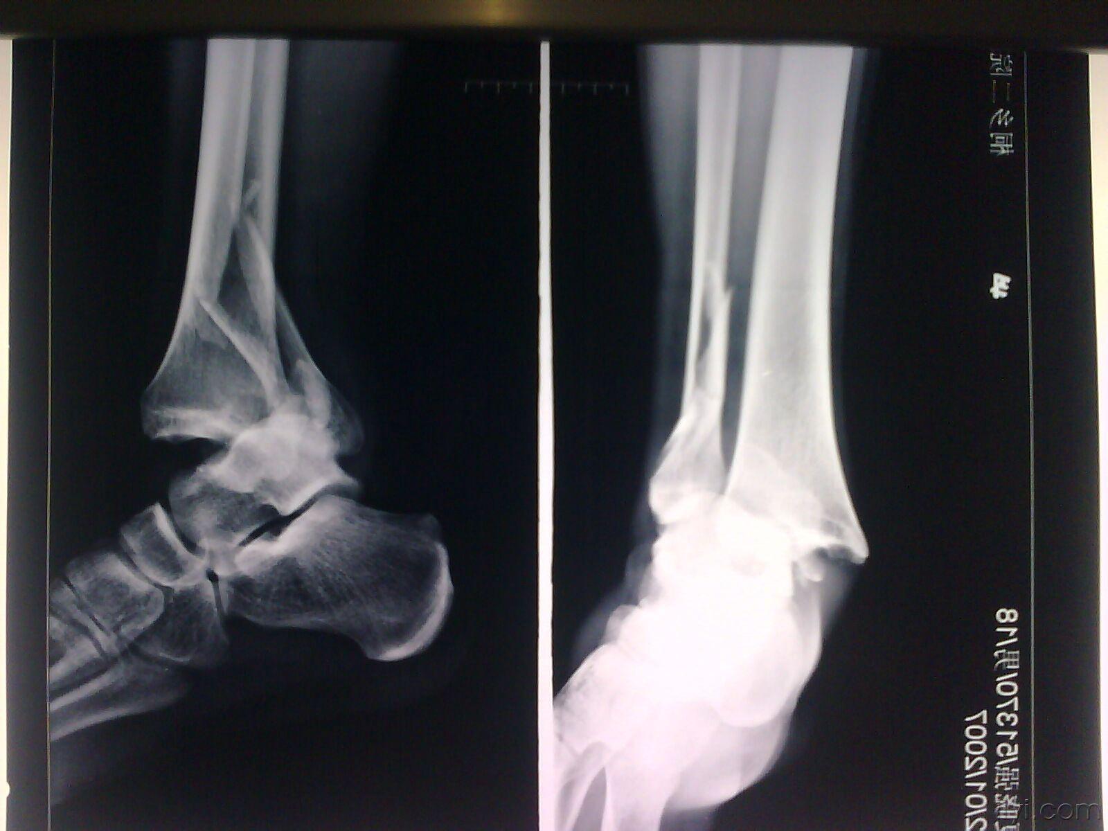 [图]三踝骨折伴踝关节脱位该怎样治疗?