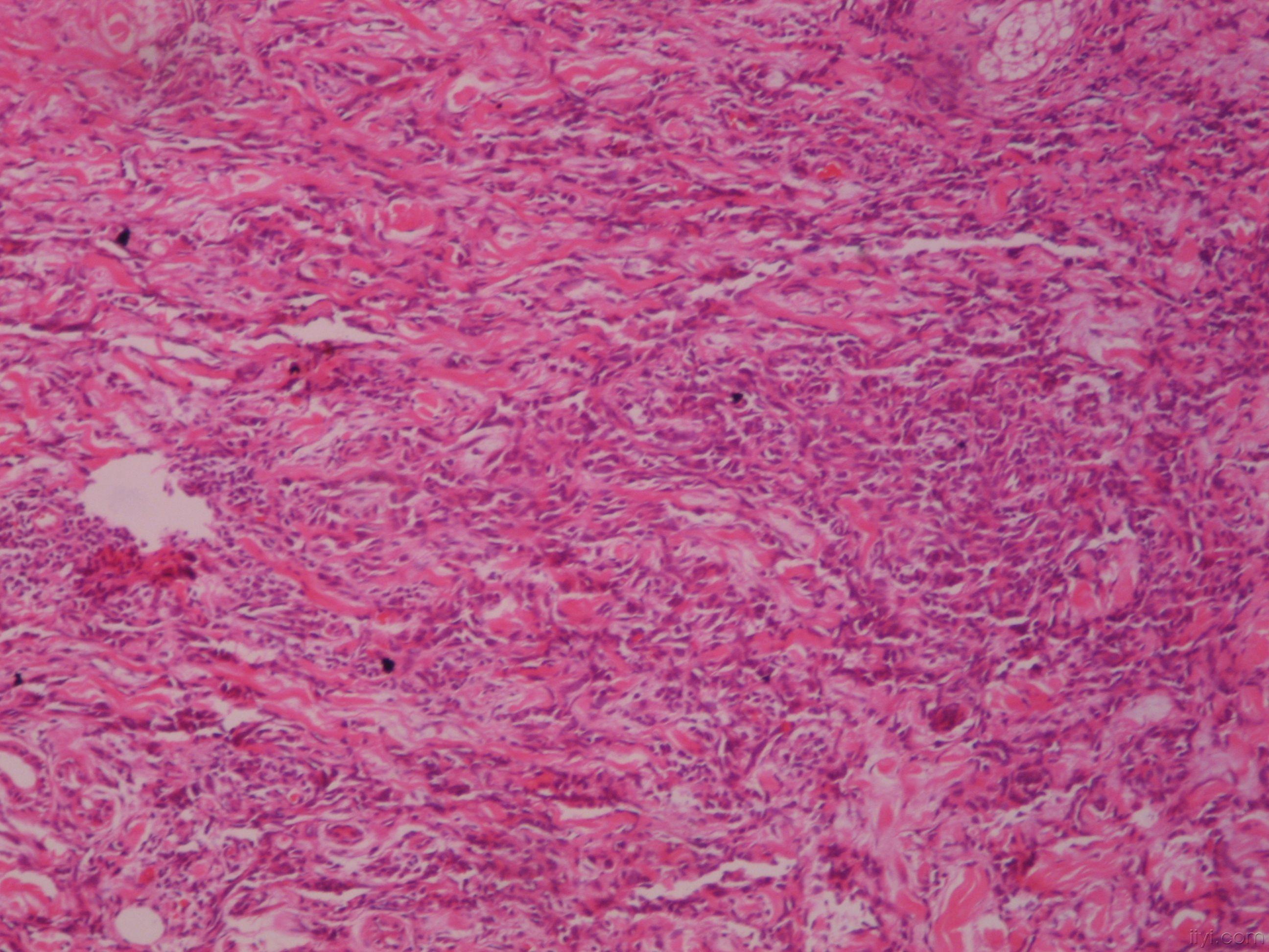 老年头面部血管肉瘤