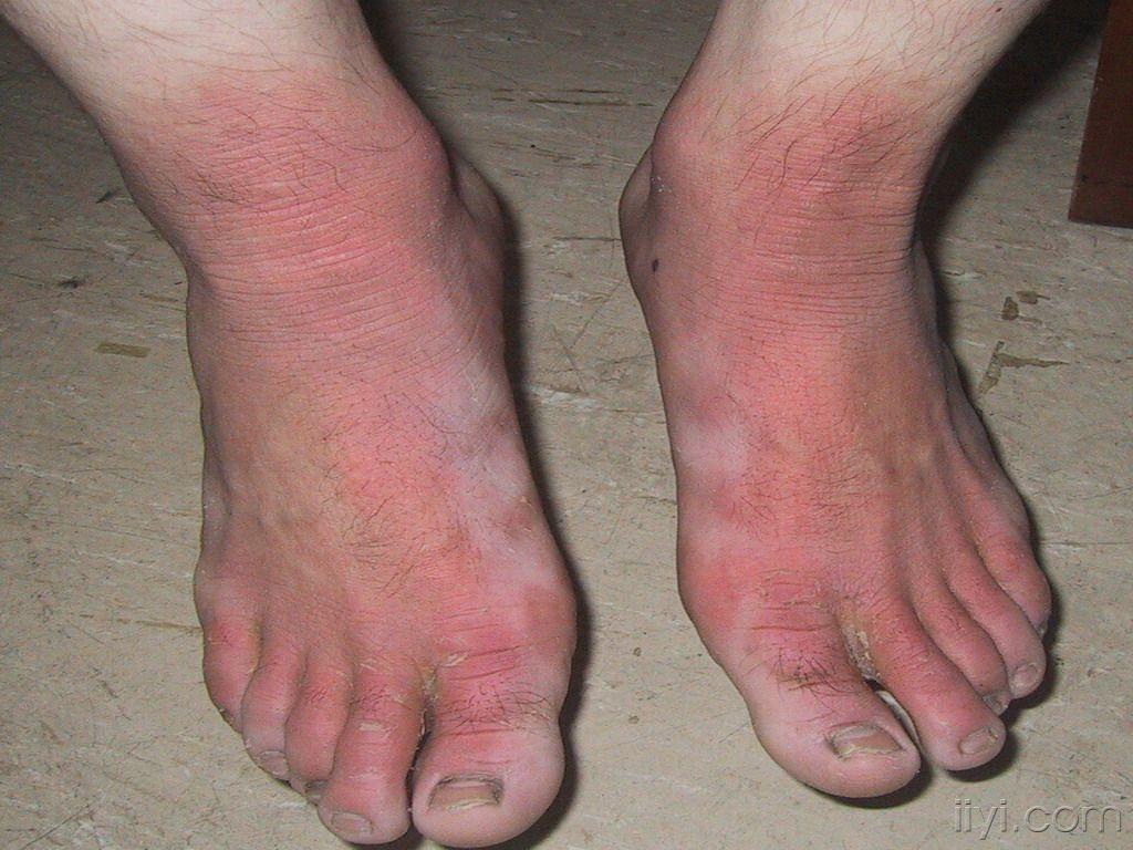 皮肤病火眼金晴