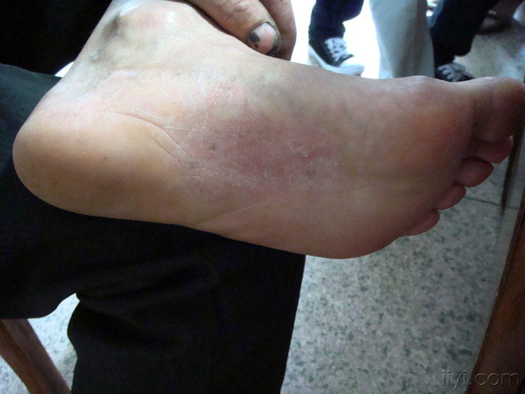 他两足底患的是什么病