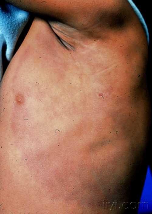 皮肤萎缩性皮炎的图片图片