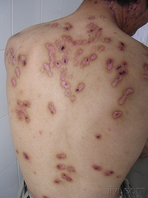 德尔塔病毒的皮疹图片图片