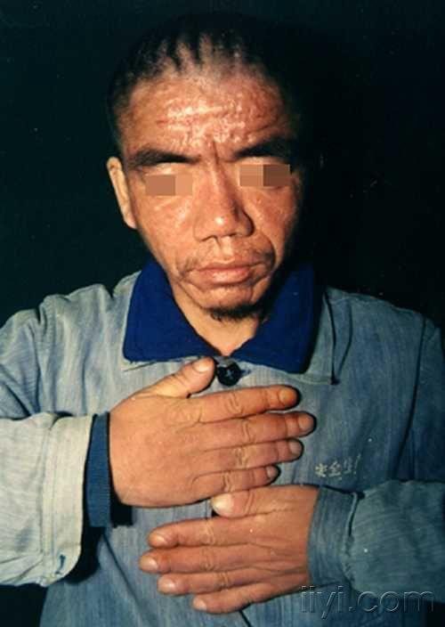 cutisverticisgyrata回状头皮