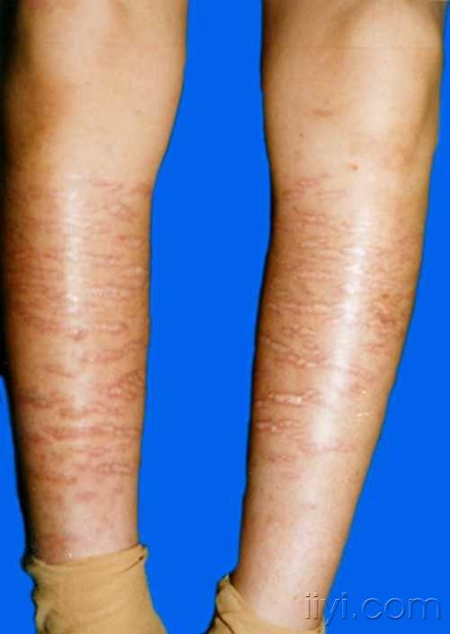 真皮及皮下组织疾病