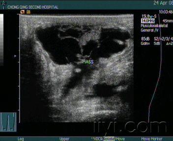 坐骨结节囊肿手术图谱图片