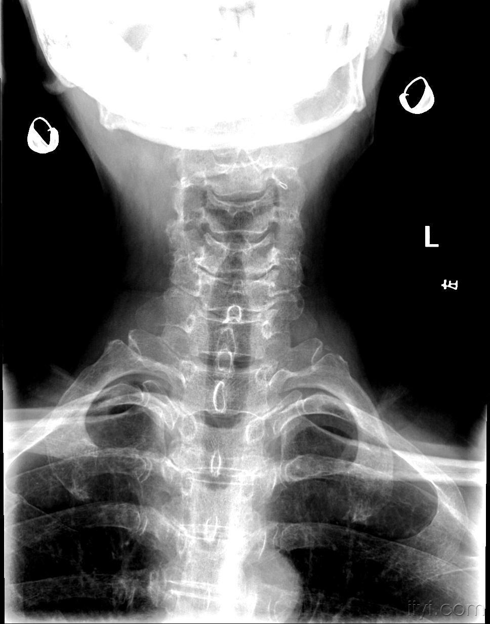 t1棘突骨折图片