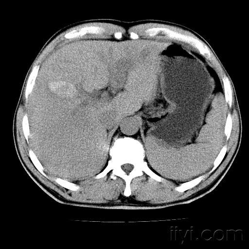 肝脏ct平扫增强