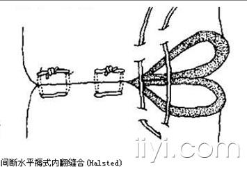 减张缝合 示意图图片