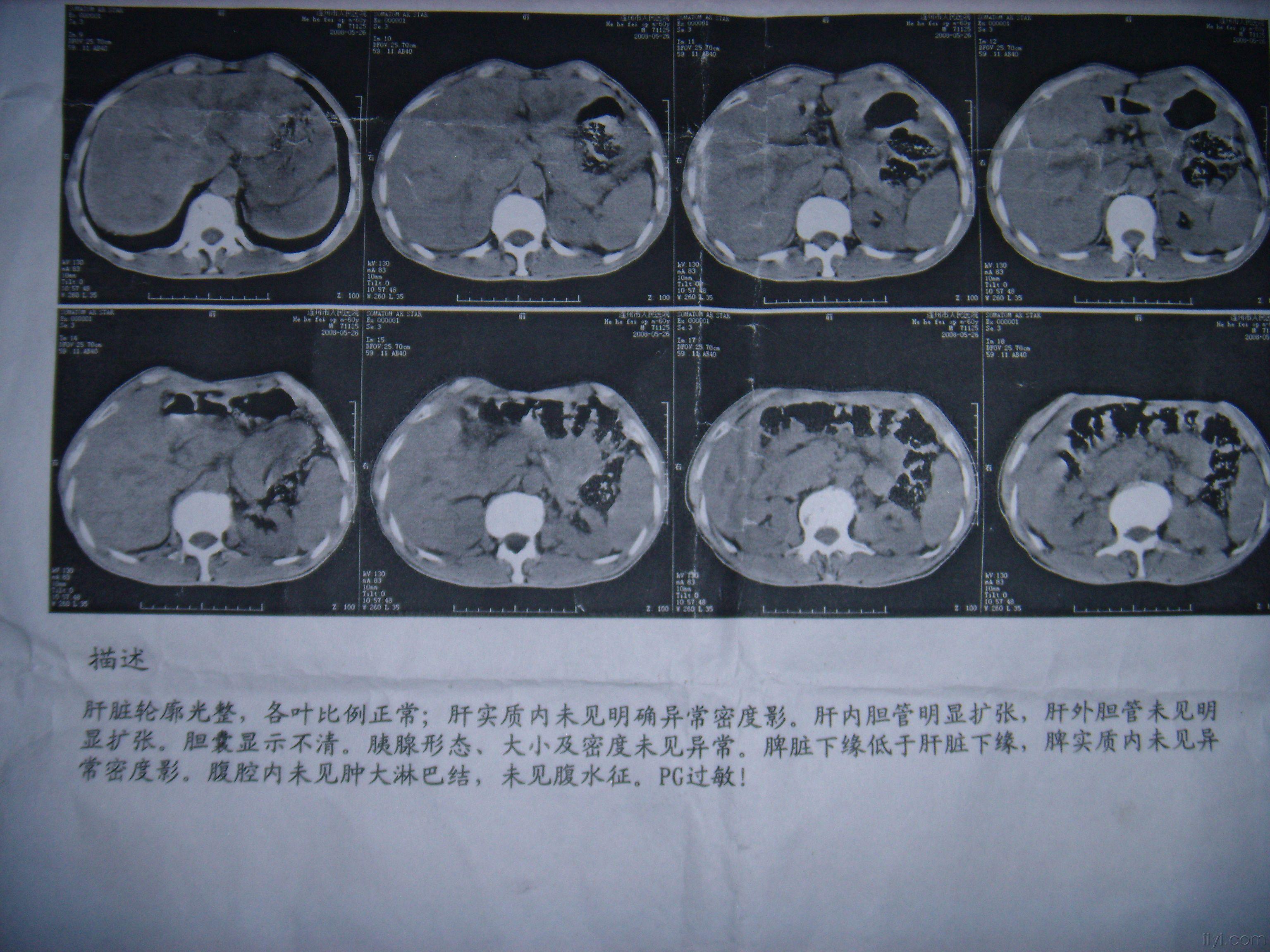 肝胆管扩张有图