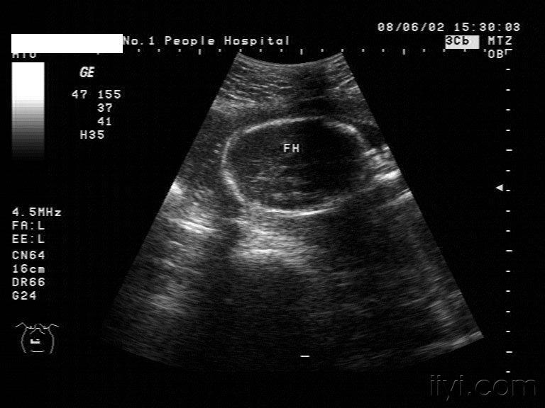 见过这种柠檬形的胎头吗