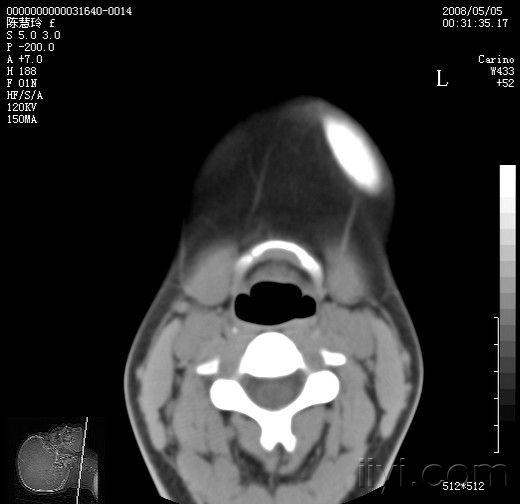 下颌骨骨纤维异常增殖
