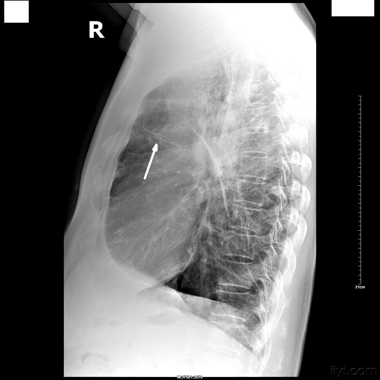 肺大泡图片胸片图片