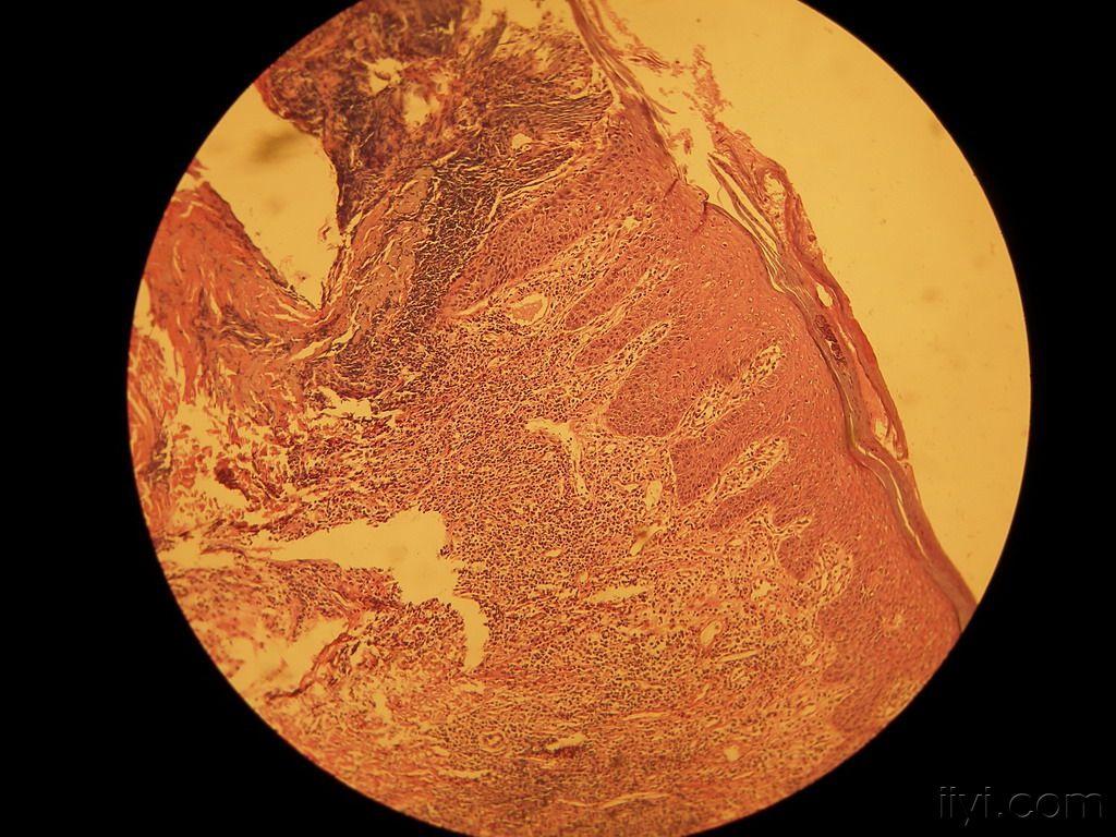 门诊病例13(银屑病)