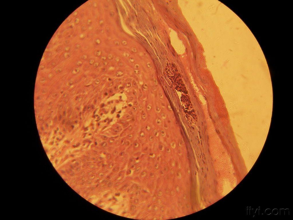 门诊病例13(银屑病)