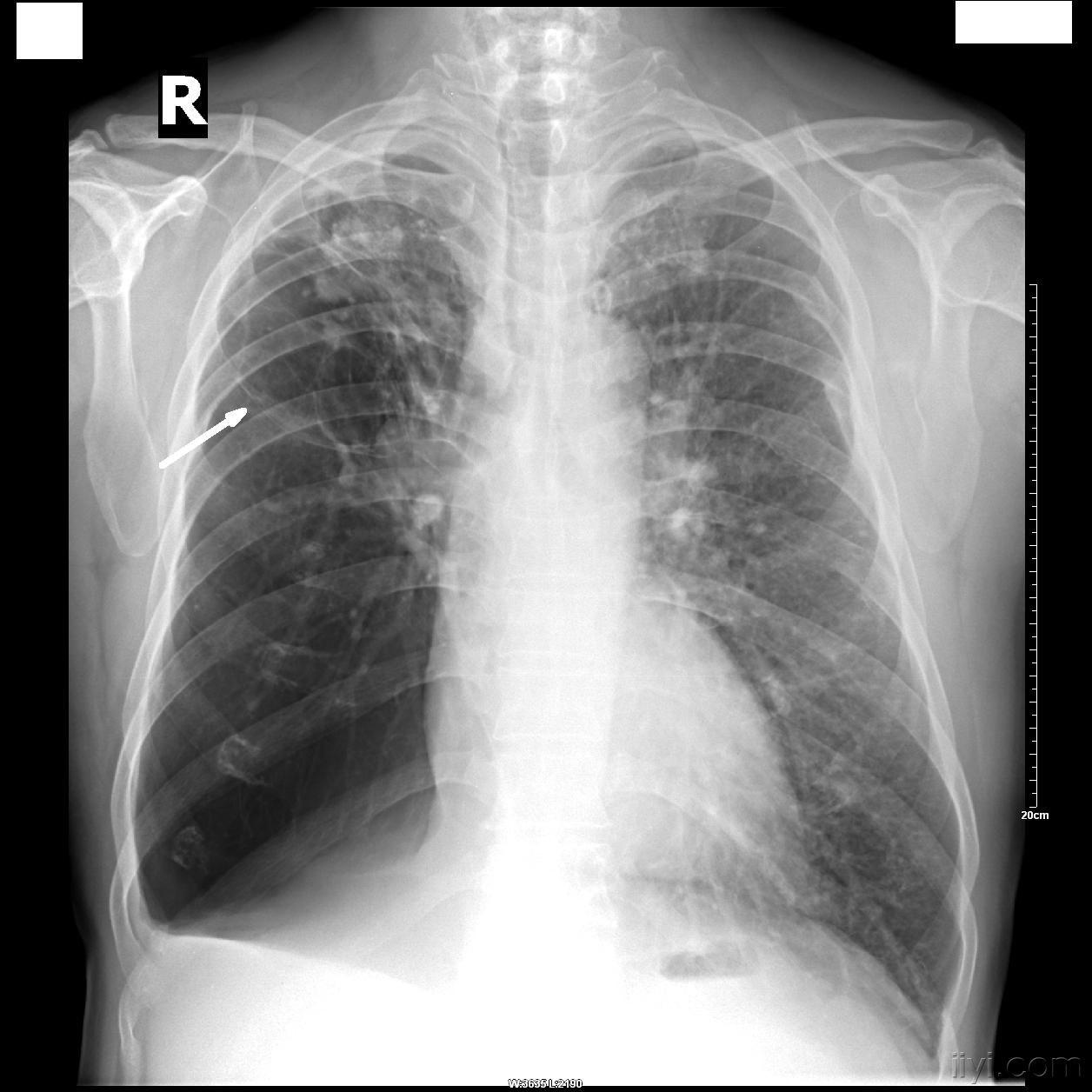 肺气肿和肺大泡ct图片图片