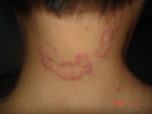 皮肤病  脂溢性皮炎