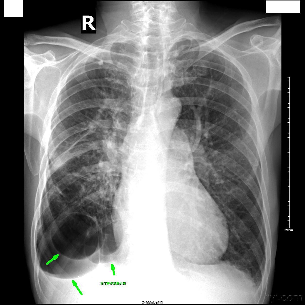 肺大泡的胸片图片图片
