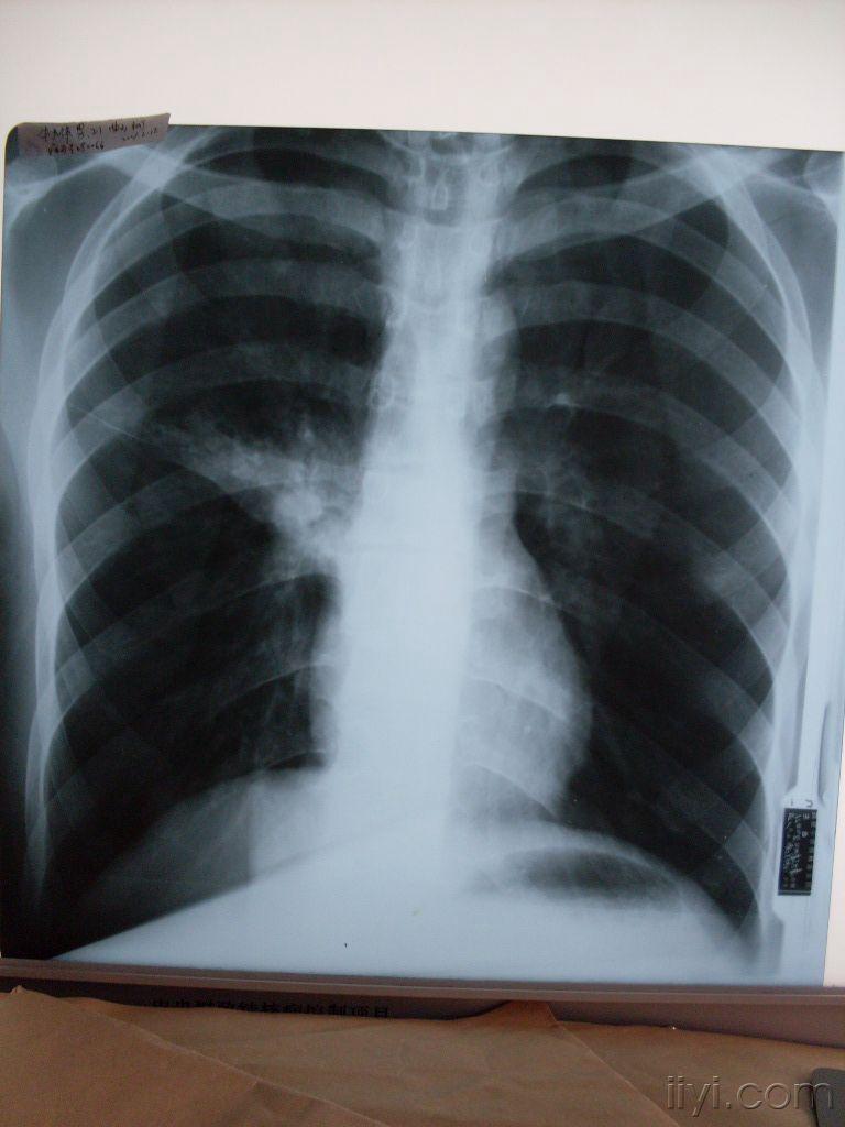 胸膜增厚x线图片图片