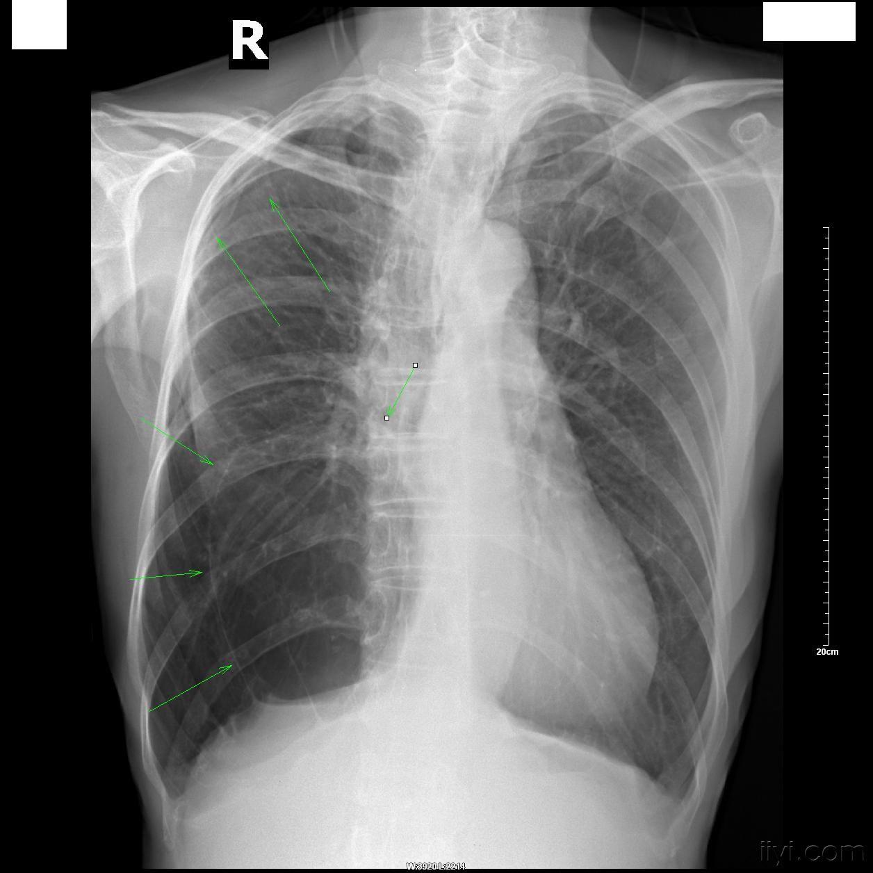 多例典型肺大泡的dr片与大家分享