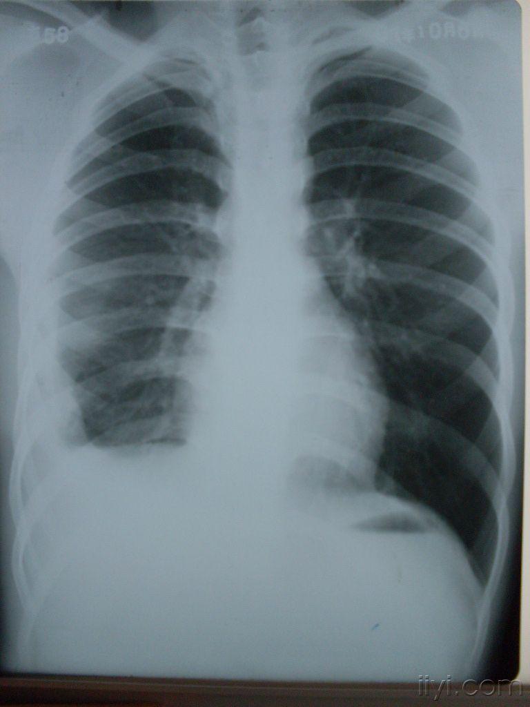 肺癌晚期图片肺积水图片
