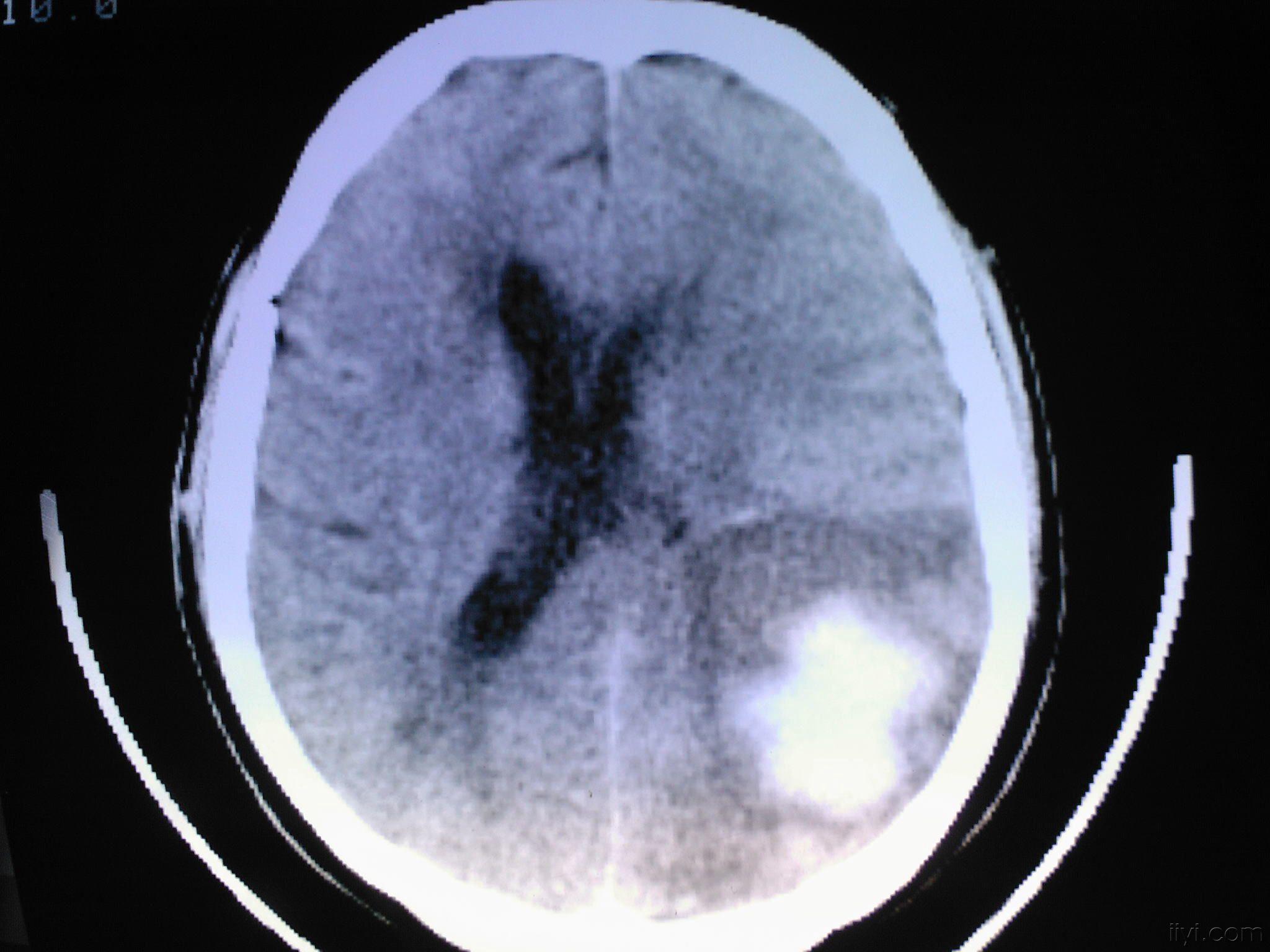 讨论右侧肢体麻木无力伴精神障碍2周