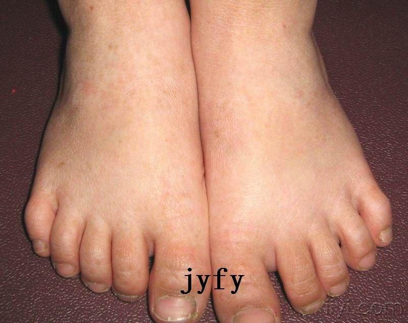 遗传性对称性色素异常症