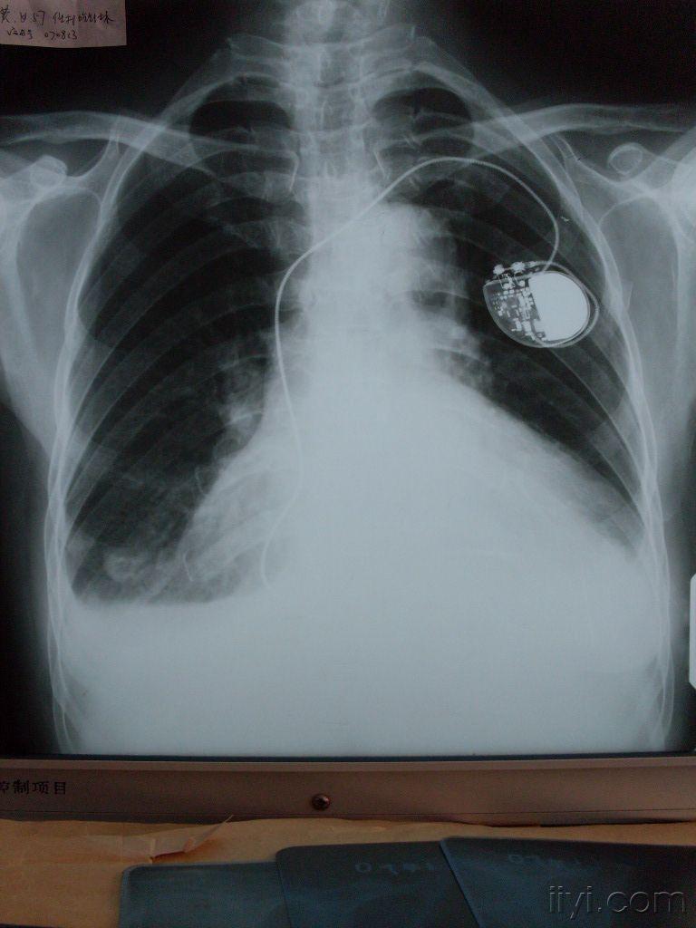 胸腔积液胸片图片