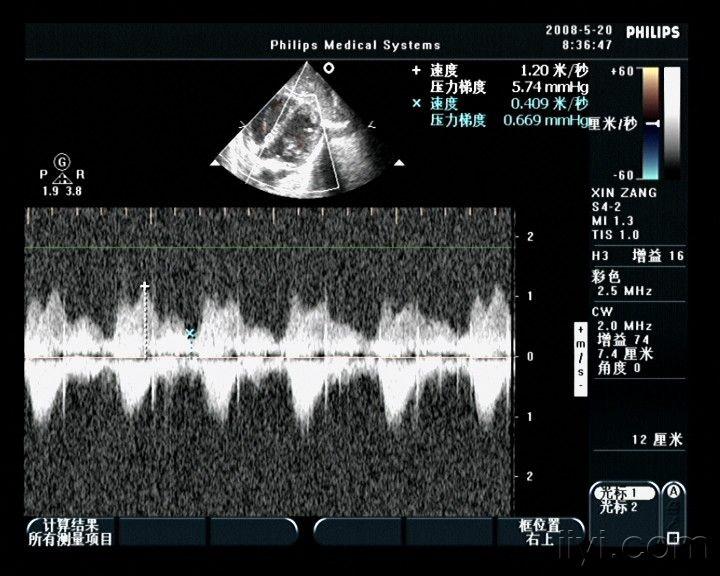心尖五腔切面分流频谱图