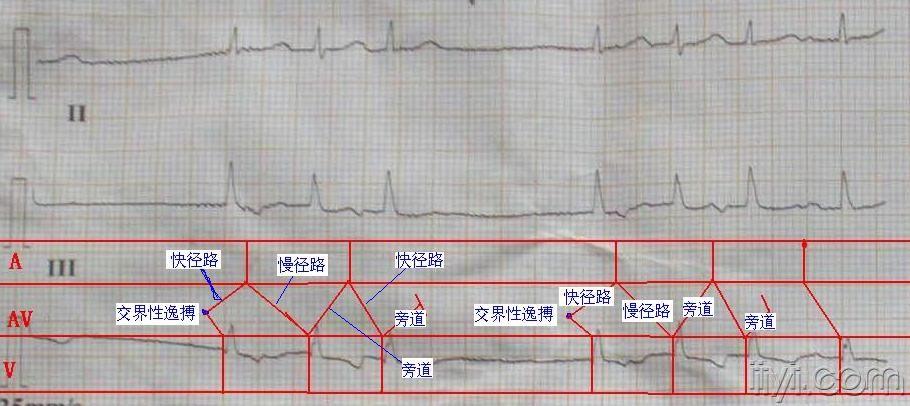 反复心律的梯形图解释
