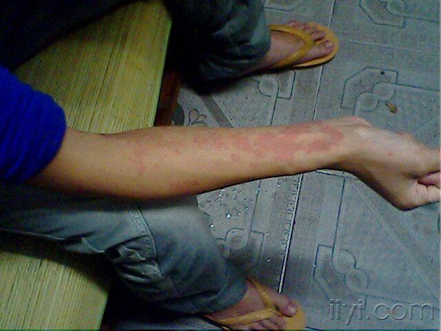 过敏的治疗传了几张图片给大家参考下