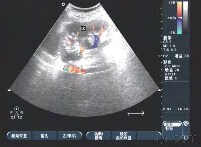 双肾盂畸形超声图片图片