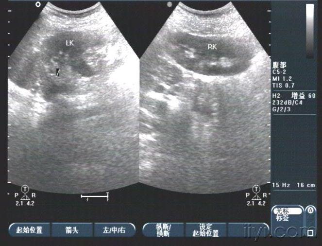 双肾盂畸形超声图片图片