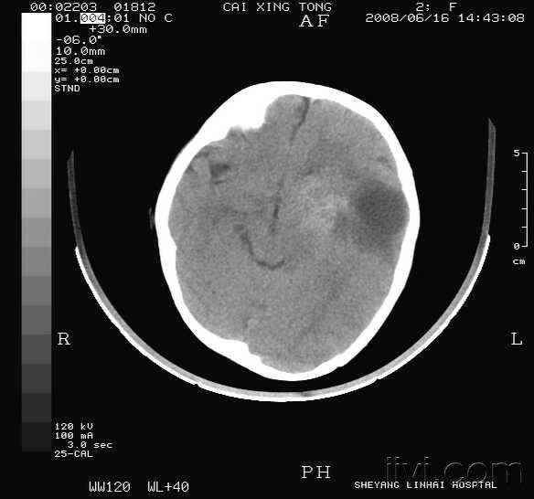 如何看懂ct片 20080616_2828881a8a82e4e45483FNO1o6T0C4lE.jpg